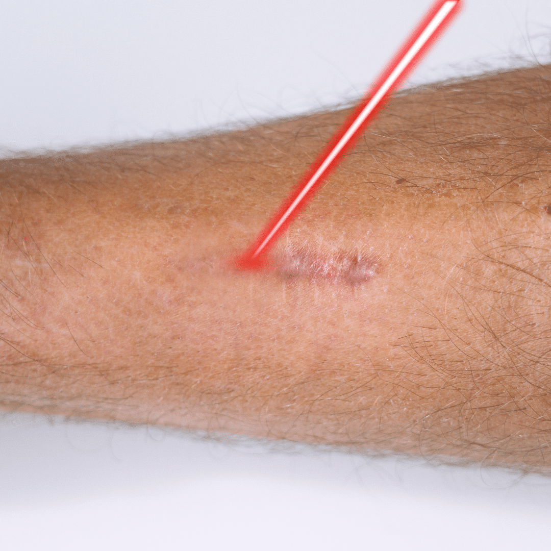 Laser scar treatment