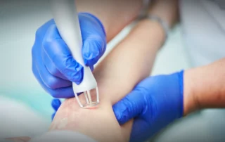 Laser stretch mark treatments in Bradenton, FL for smoother skin