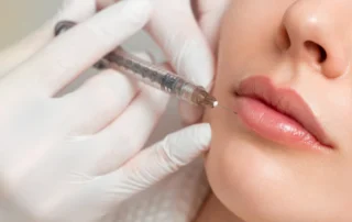 Close-up of lips with fillers showcasing longevity and results in Lakewood Ranch FL